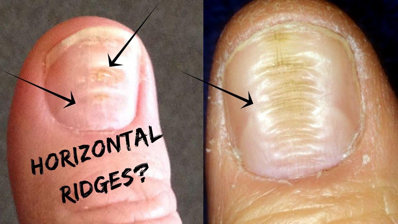 'Video thumbnail for Do You Have These Horizontal Ridges On Your Nails?-Palmistry'